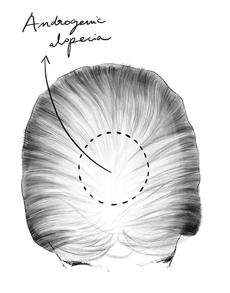 Androgene Alopezie bei Frauen