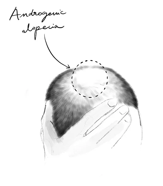 Androgene Alopezie bei Männern