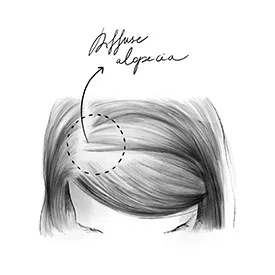 Diffuse Alopezie