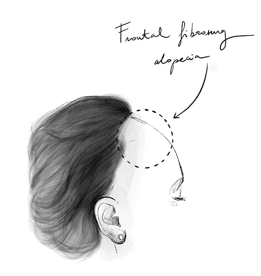 Frontale fibrosierende Alopezie