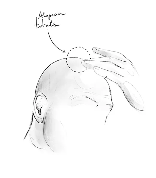 Totale Alopezie